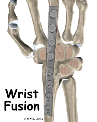 Wrist Fusion