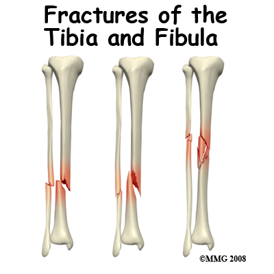 Adult Lower Leg Fractures