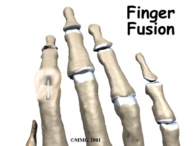 Finger Fusion Surgery - Healing Joints Guide