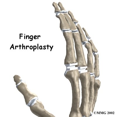 Artificial Joint Replacement of the Finger - Healing Joints Guide